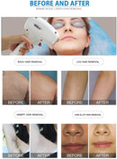 Diodenlaser-Haarentfernungsgerät Laser Dauerhafte Haarentfernung 3 Wellenlängen-3