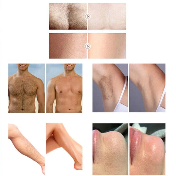 Diodenlaser-Haarentfernungsgerät Laser Dauerhafte Haarentfernung 3 Wellenlängen