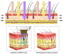 Diodenlaser-Haarentfernungsgerät Laser Dauerhafte Haarentfernung 3 Wellenlängen-20