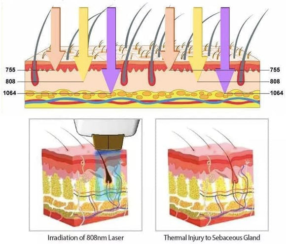 Diodenlaser-Haarentfernungsgerät Laser Dauerhafte Haarentfernung 3 Wellenlängen